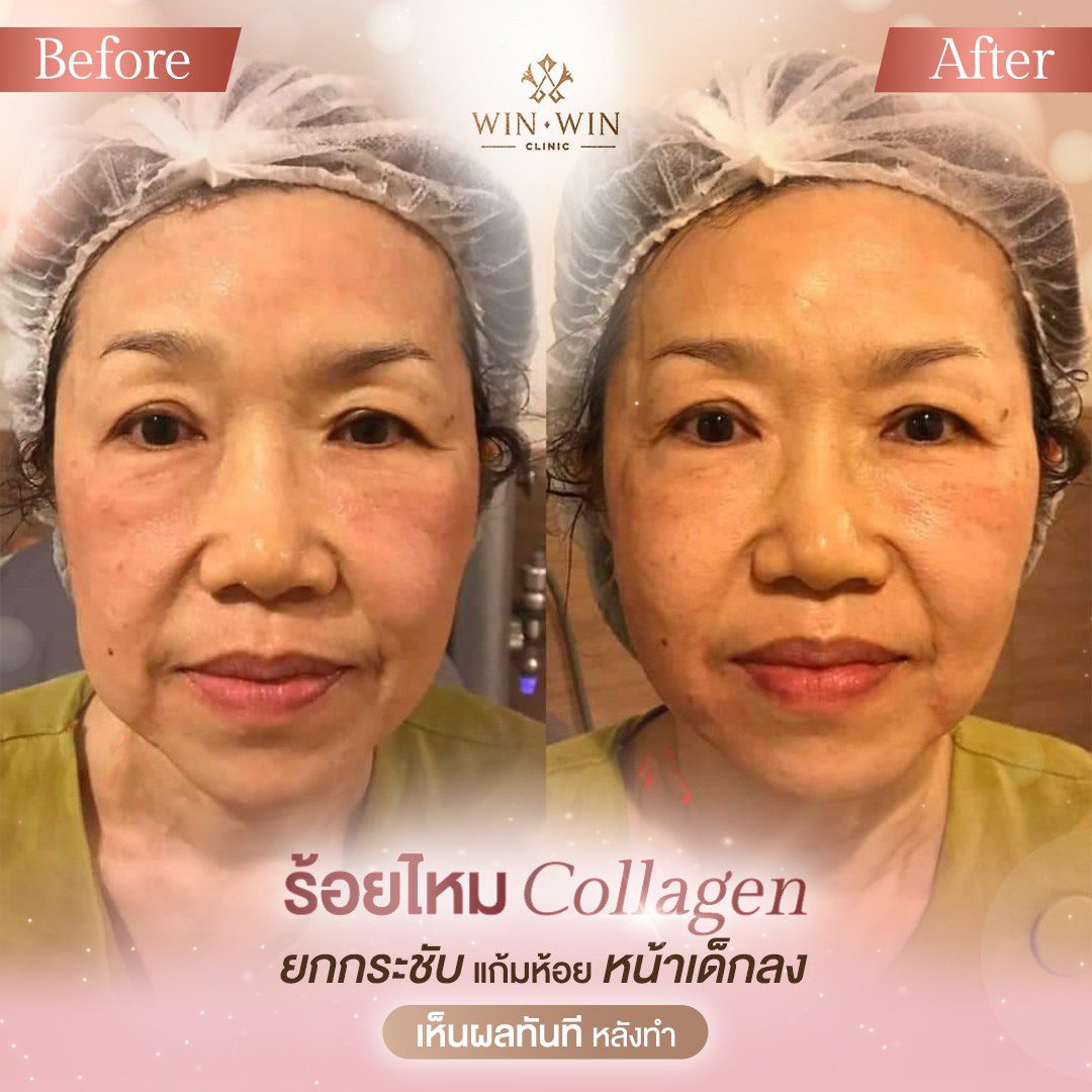 รีวิวหลังร้อยไหม COLLAGEN ยกกระชับแก้มห้อย